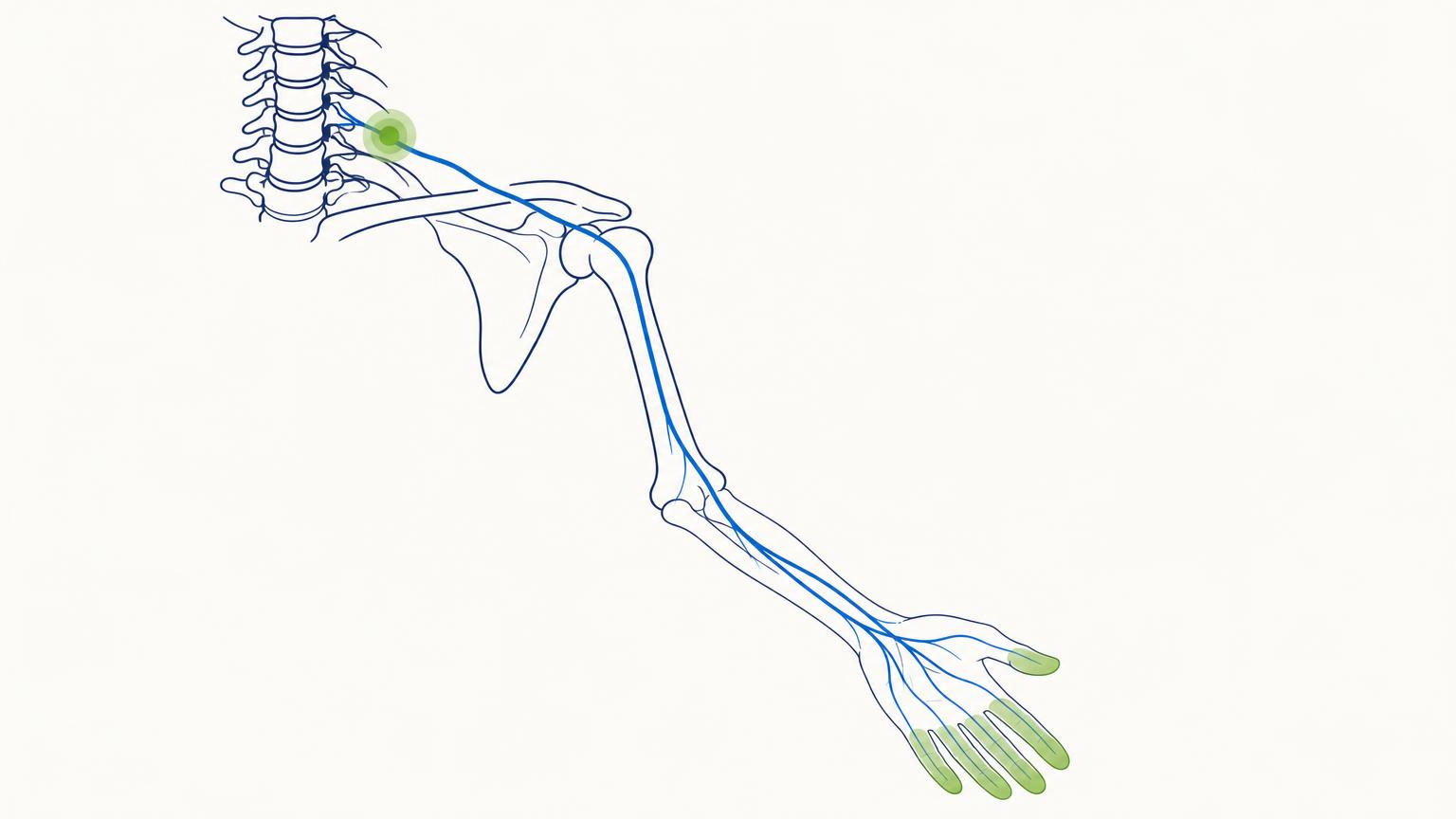 Diagram showing a nerve running from the neck to the hand, with the source of irritation at the neck and the symptoms appearing in the fingers.
